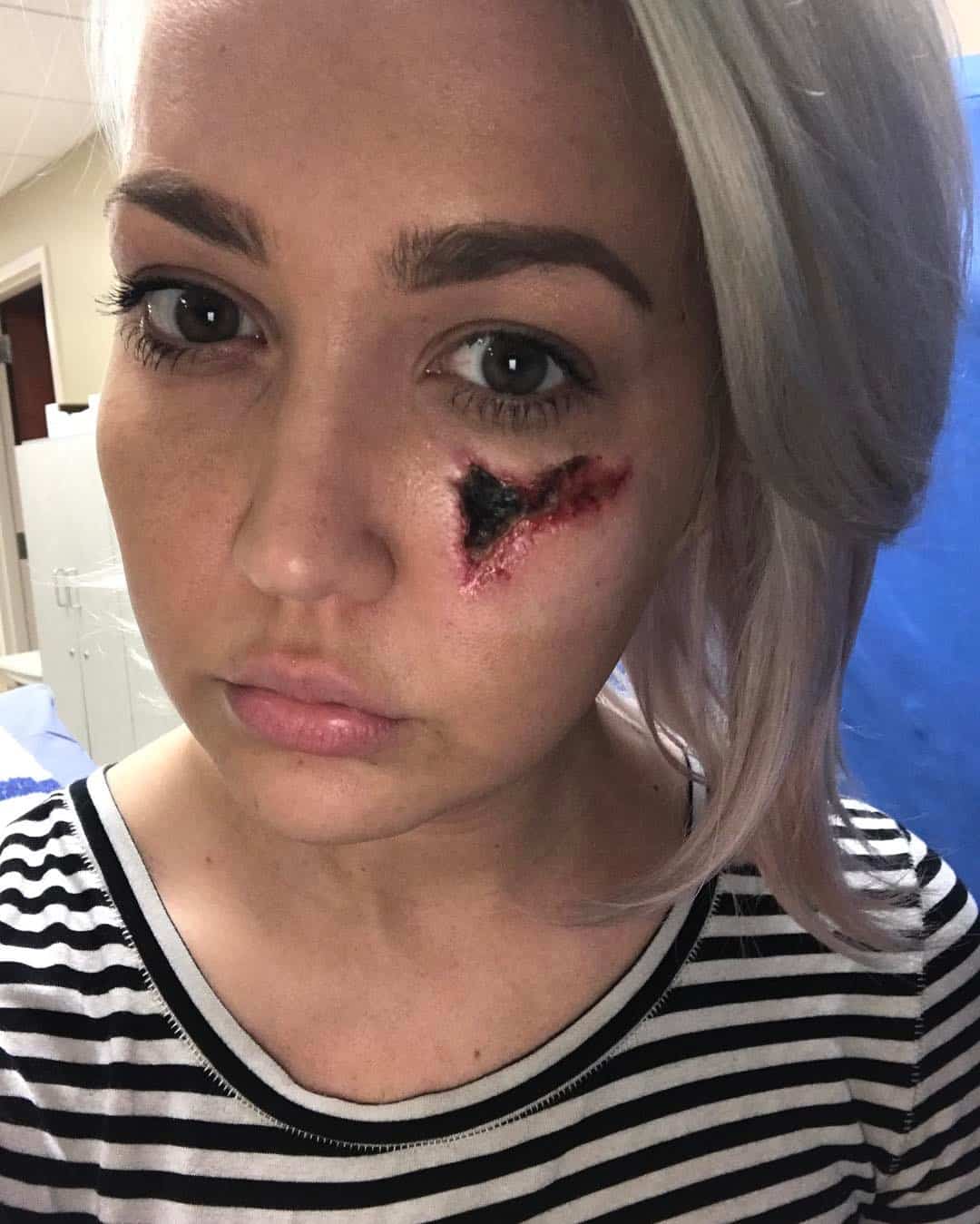 A forma que ela conseguiu essa cicatriz no rosto vai fazer você perder o sono!