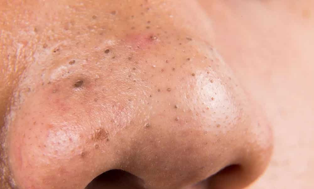 4 formas, que funcionam, de evitar e remover cravos da pele
