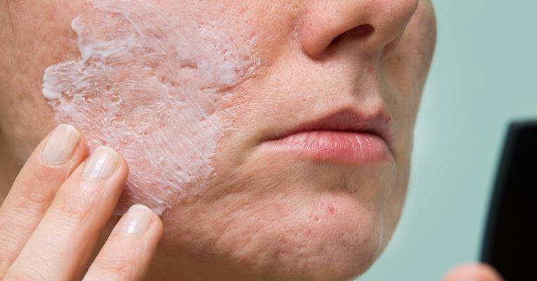 5 truques para eliminar marcas de espinha da pele