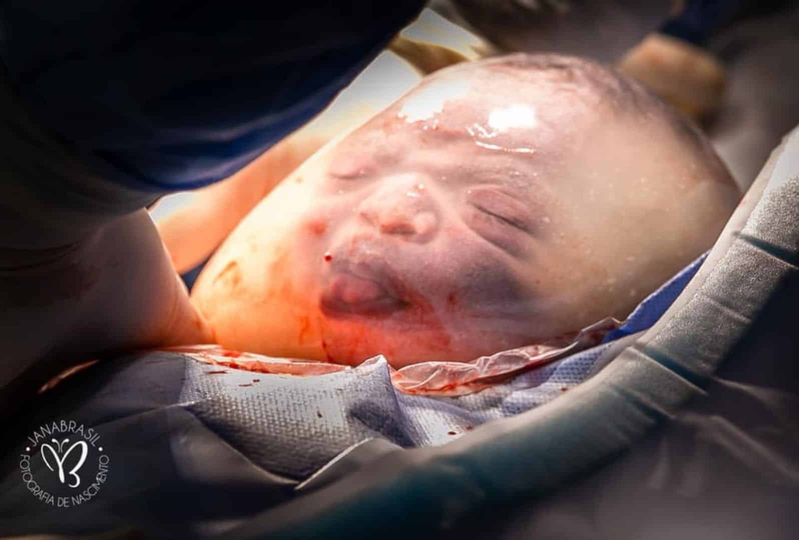 Bebê dentro da bolsa amniótica: Parto raro acontece no ES e encanta mãe
