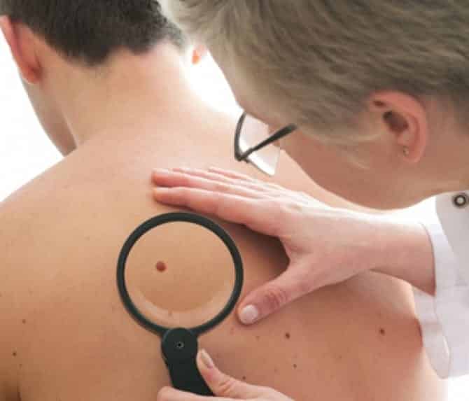 Fique atenta ao câncer de pele e saiba quando é hora de procurar um médico
