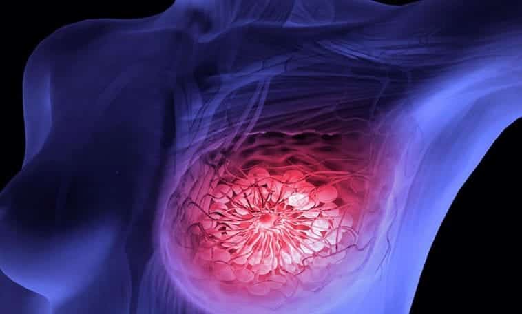 Câncer de mama, tudo sobre o mal mais comum entre mulheres no mundo