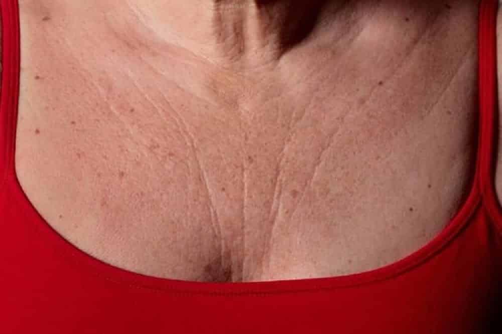 8 medidas para evitar e acabar com as rugas no peito