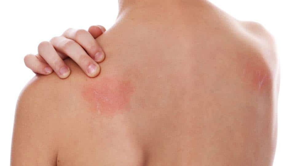 18 problemas que causam manchas vermelhas na sua pele