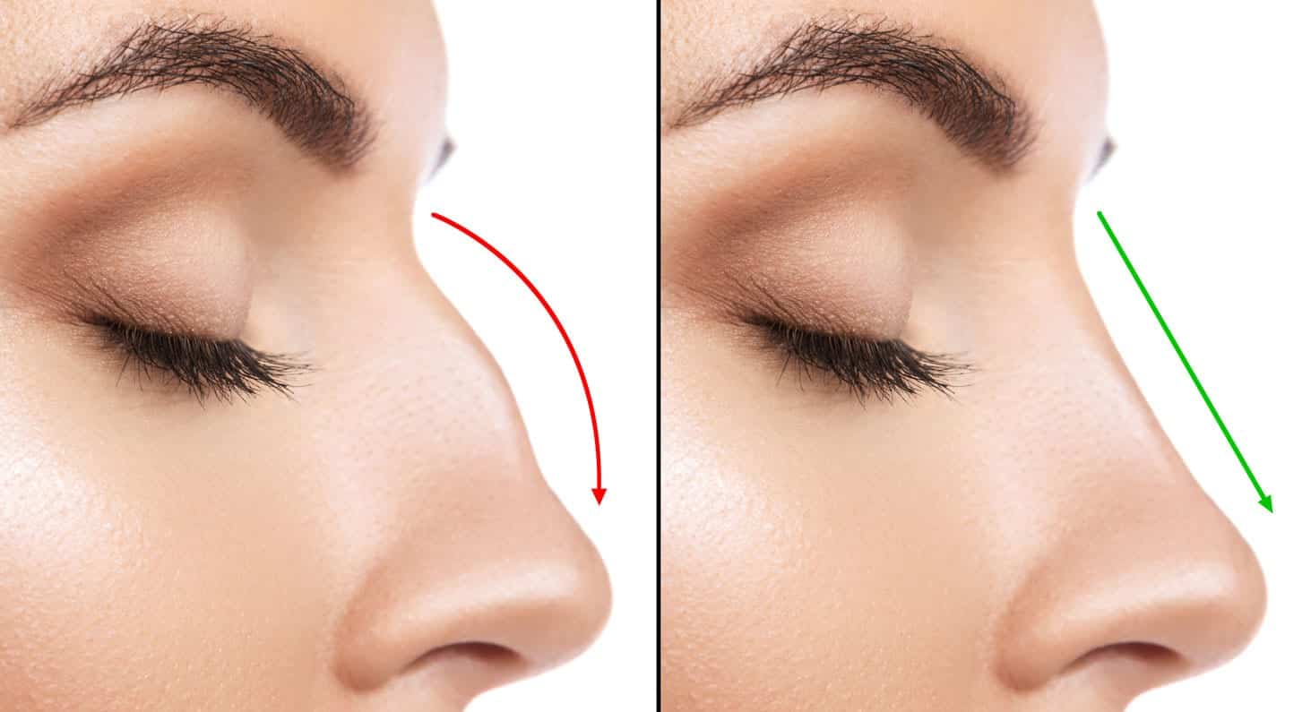 Afinar o nariz- Como fazer, o que fazer, com maquiagem ou cirurgia?