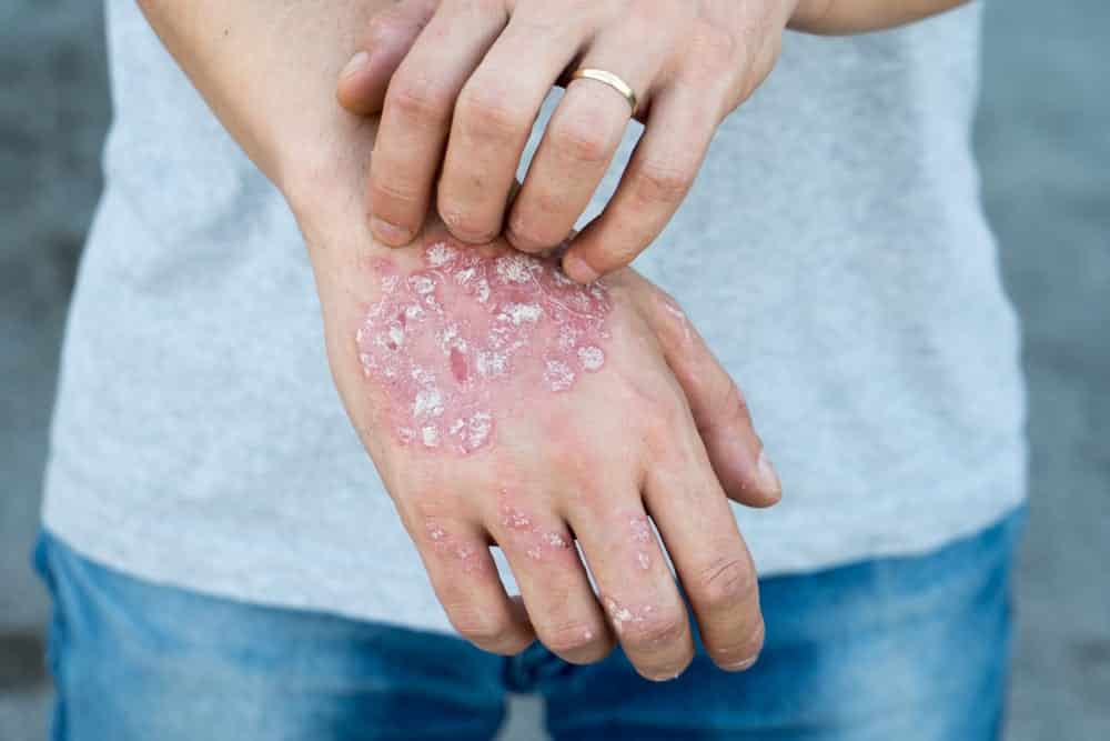 Problemas de pele - doenças que causam mancha na pele
