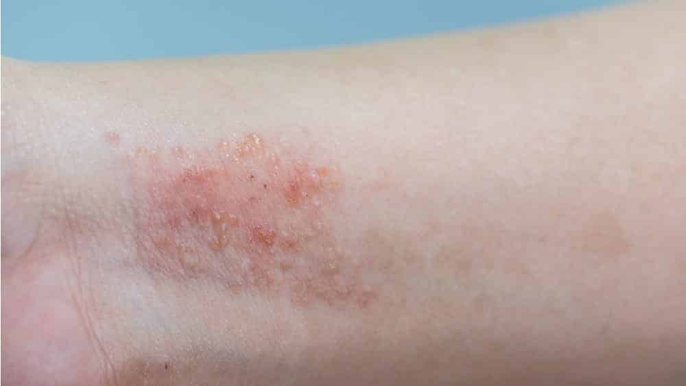 Problemas de pele - doenças que causam mancha na pele
