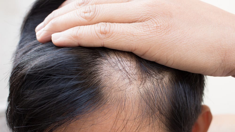 Alopecia areata é uma doença que provoca a queda de cabelo