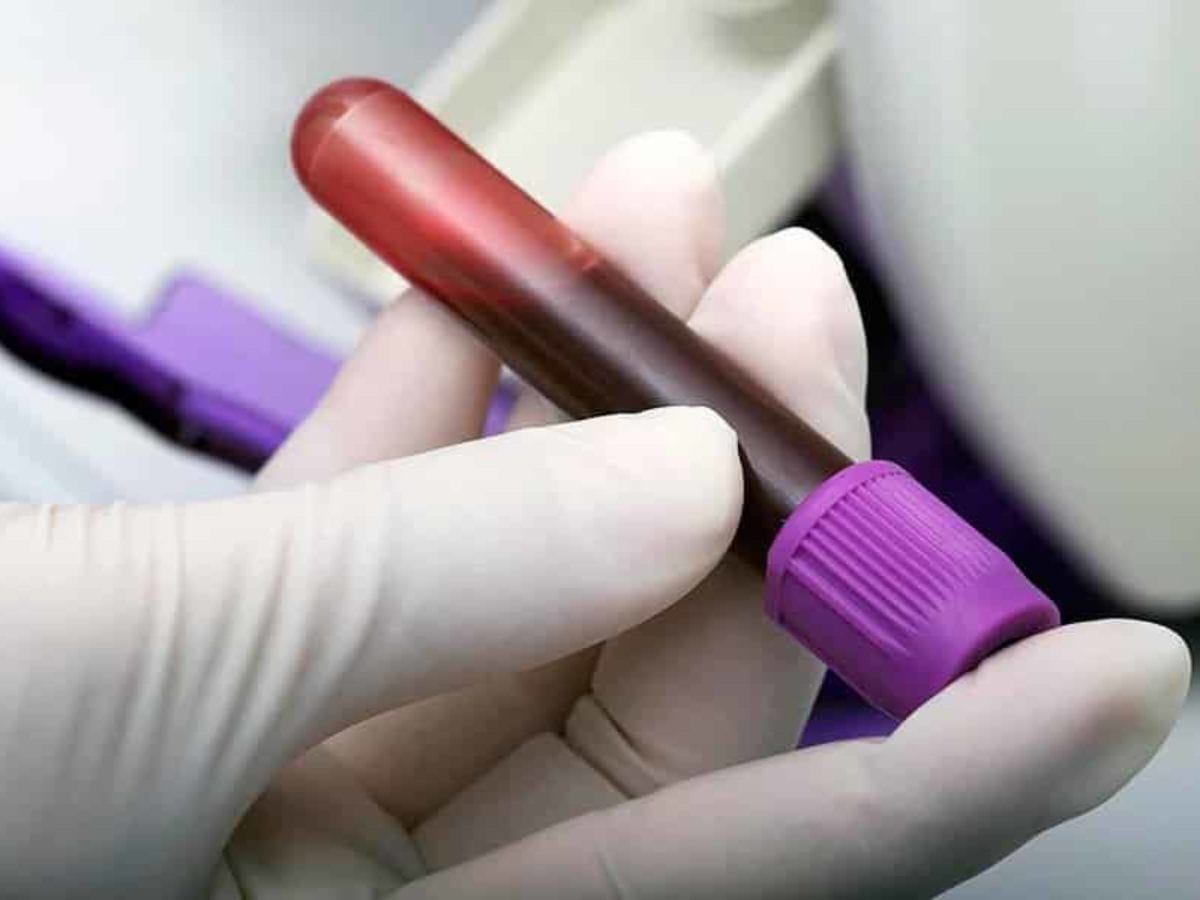 Exame de gravidez de sangue como funciona? O que é Beta HCG?