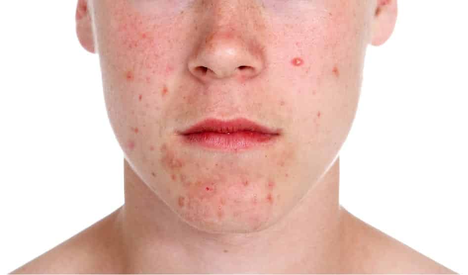 Anticoncepcional para acne? Saiba se o remédio realmente combate isso