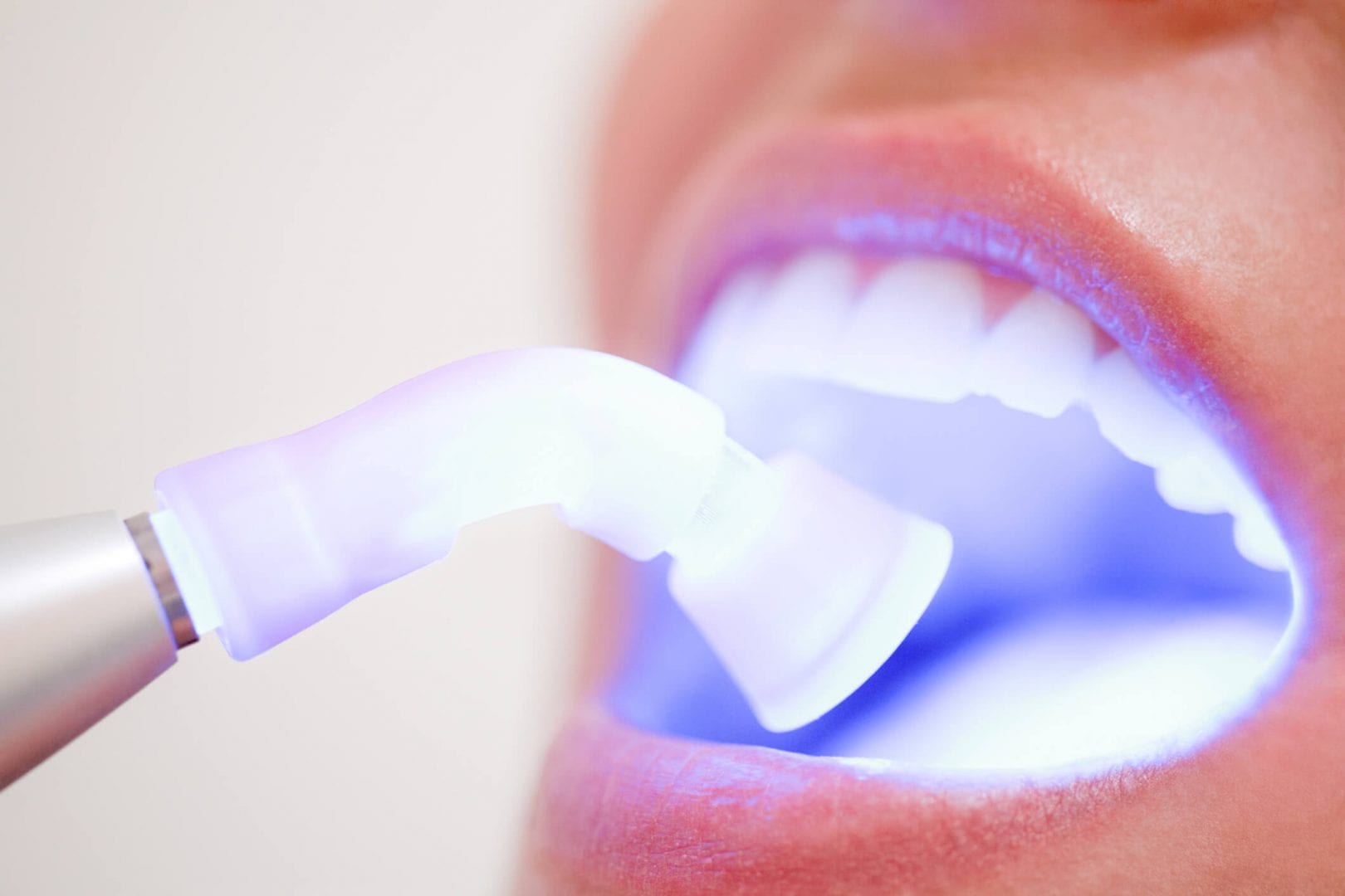 Dentes brancos- principais tratamentos de consultório e também caseiros