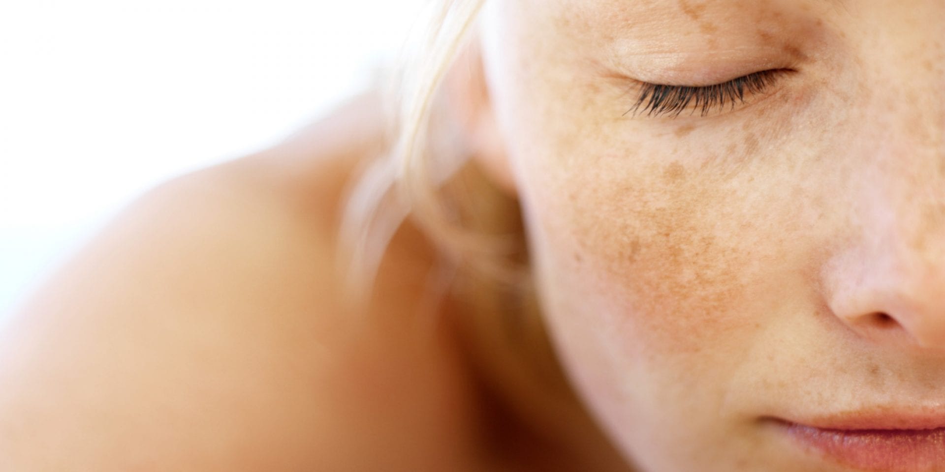 Manchas escuras na pele: O que é, tipos e tratamentos