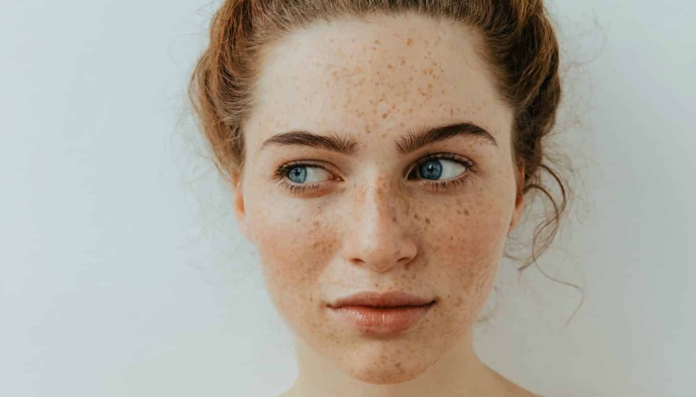 Manchas escuras na pele: O que é, tipos e tratamentos