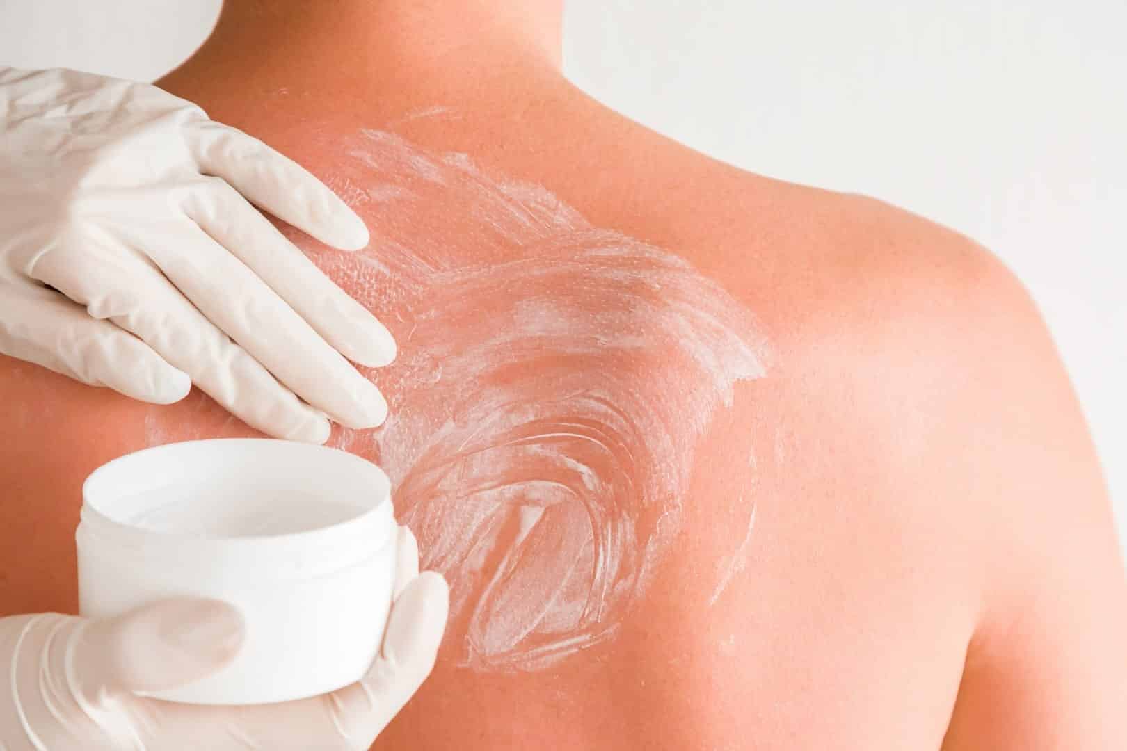 Queimadura de sol- o que causa na pele, como evitar e tratamentos