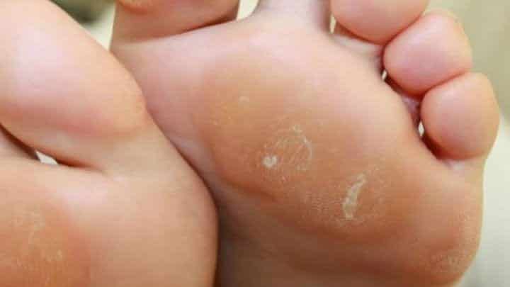 Calos nos pés - o que são, como prevenir e quais os tratamentos