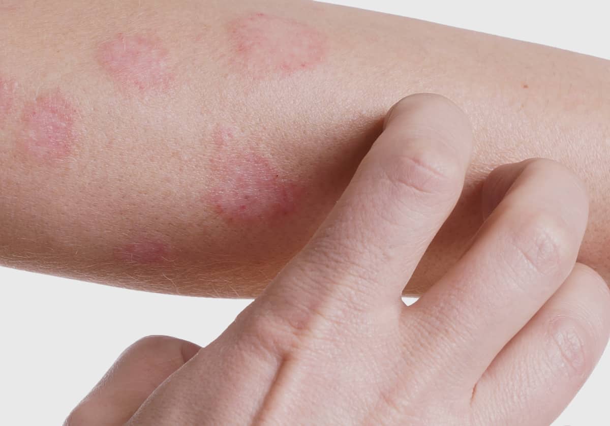 Dermatite - o que é, sintomas, tipos doença e como tratar