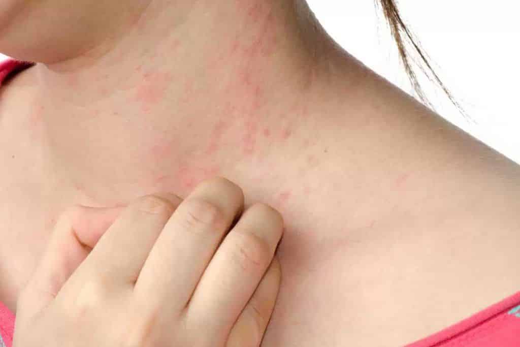 Alergia a perfume — o que causa, sintomas e como evitar crises alérgicas