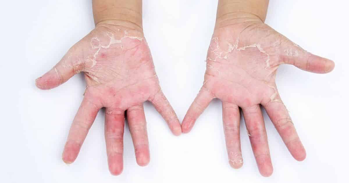 Alergia nas mãos - Possíveis causas, sintomas e tratamentos