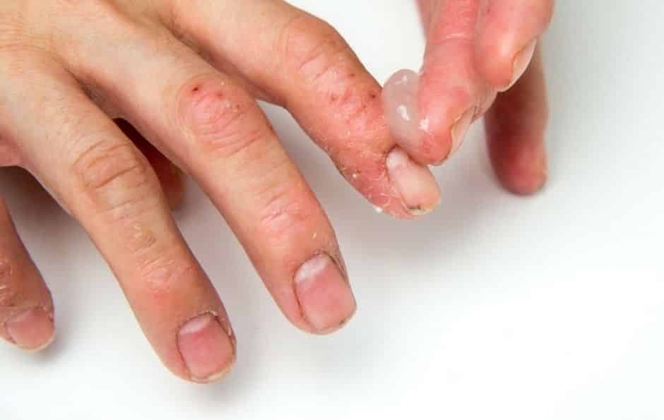 Alergia nas mãos - Possíveis causas, sintomas e tratamentos