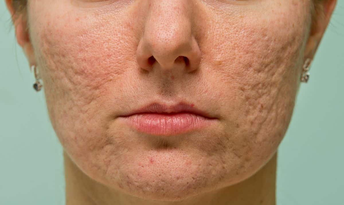 Cicatrizes de acnes