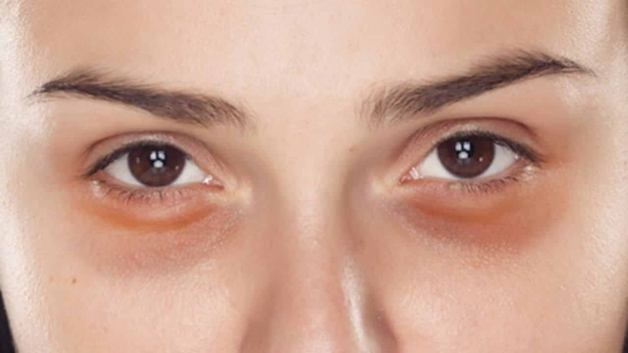 Tipos de olheiras – Veja qual a sua e como cuidar