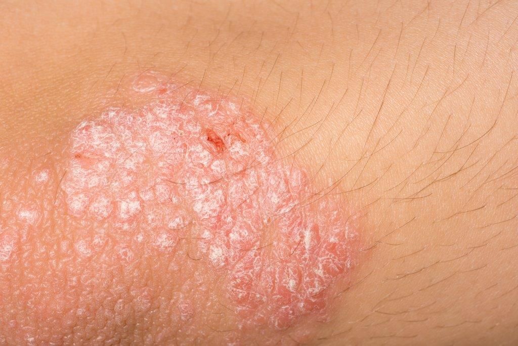 Mancha vermelha na pele – Descubra as causas