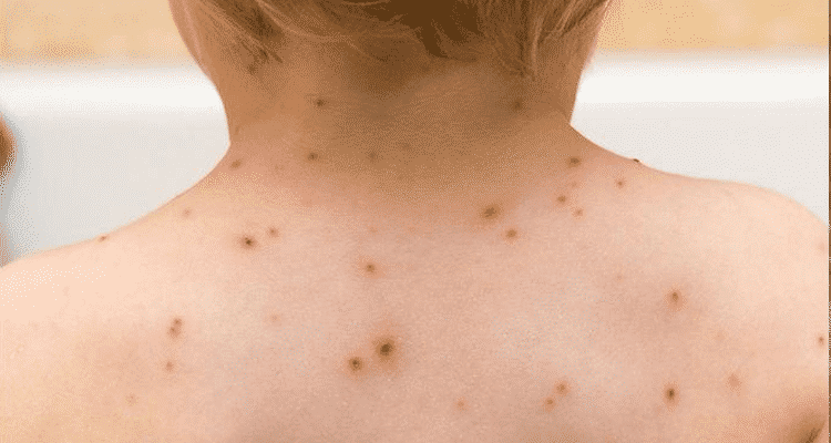 Mancha vermelha na pele – Descubra as causas