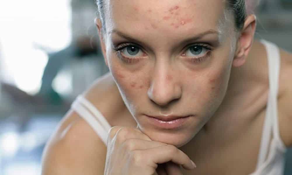 Anticoncepcional para acne - Benefícios e contraindicações
