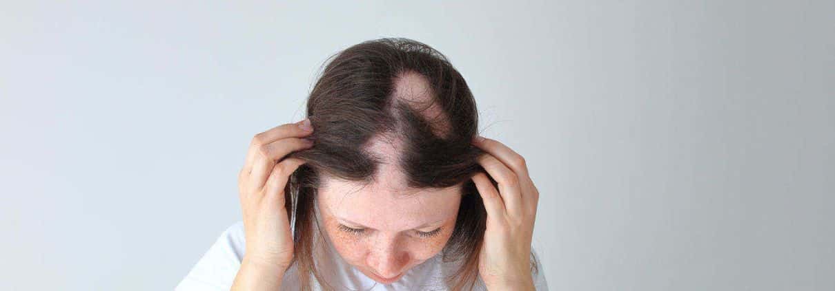 O que é alopecia? – queda de cabelo