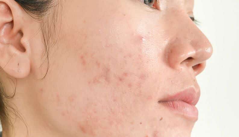 Sabonete para acne, como escolher o ideal? 12 melhores produtos