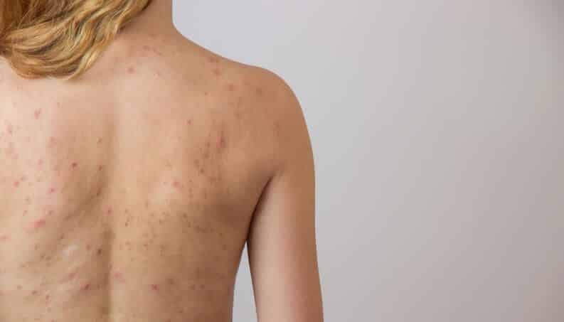 Tipos de espinhas - Diferenças, tratamentos e prevenção para acnes