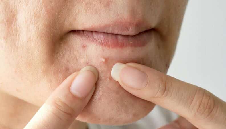 Tipos de espinhas - Diferenças, tratamentos e prevenção para acnes