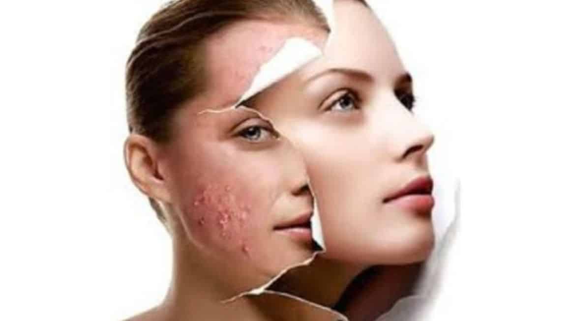 Tratamentos para acne - Tipos de acne e o que fazer em cada caso