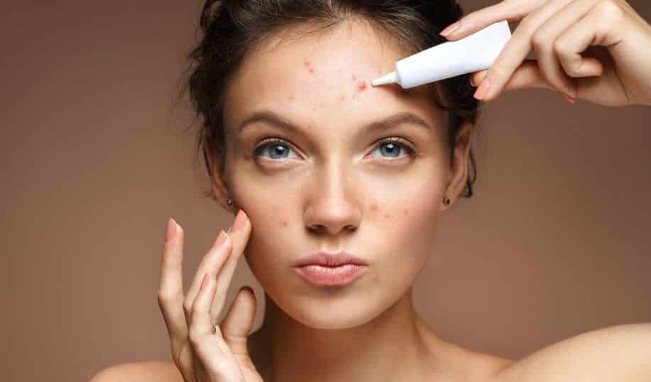 Tratamentos para espinha - saiba como evitar a acne