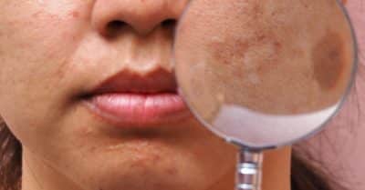 Cicatriz De Acne Formas De Prevenir E Remediar As Imperfei Es