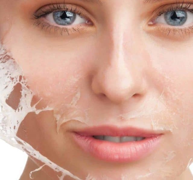 Cicatriz de acne: 8 formas de prevenir e remediar as imperfeições