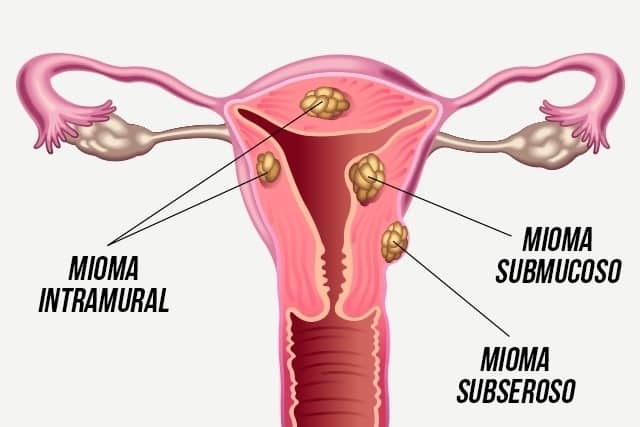 Coágulo na menstruação: 7 possíveis causas + como tratar