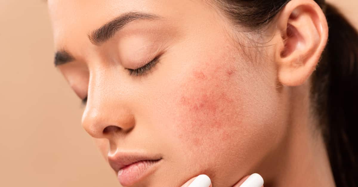 Tipos de manchas no rosto: o que causam e tratamentos