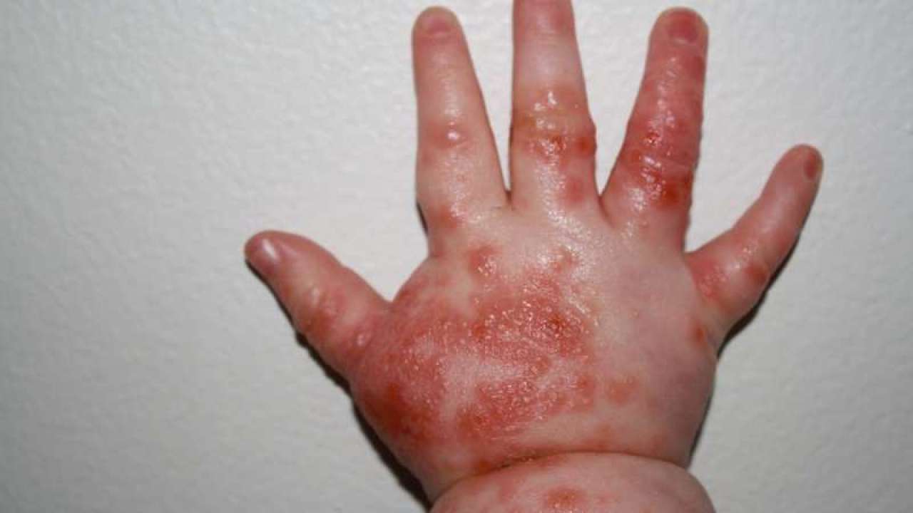 Doença mão-pé-boca: causas, sintomas, cuidados e tratamentos