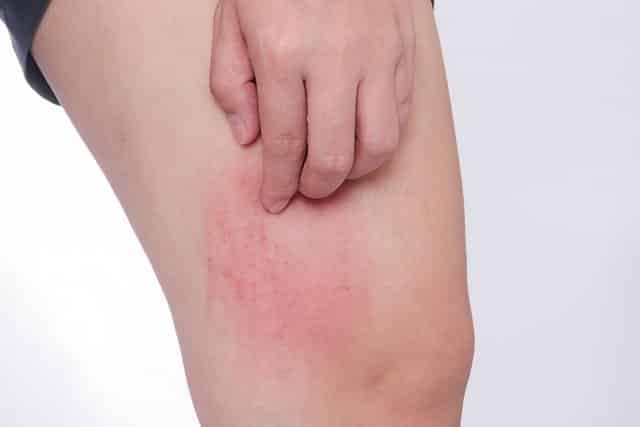 15 doenças que causam manchas vermelhas na pele