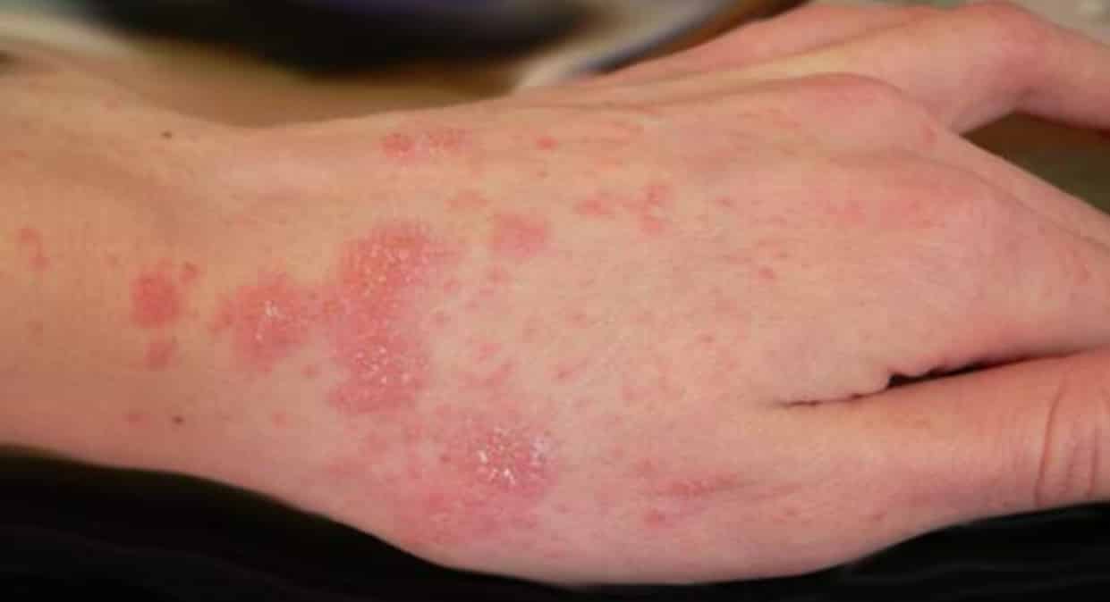 15 doenças que causam manchas vermelhas na pele