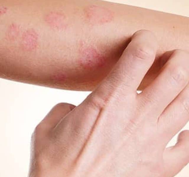18 doenças que causam manchas vermelhas na pele