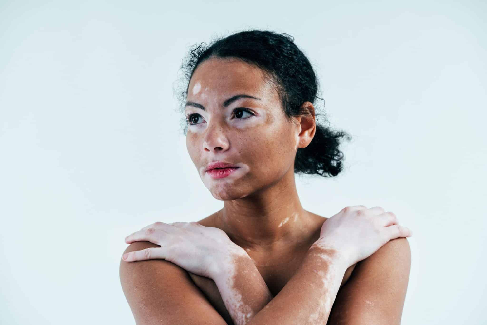 5 dicas de skincare para pele com vitiligo