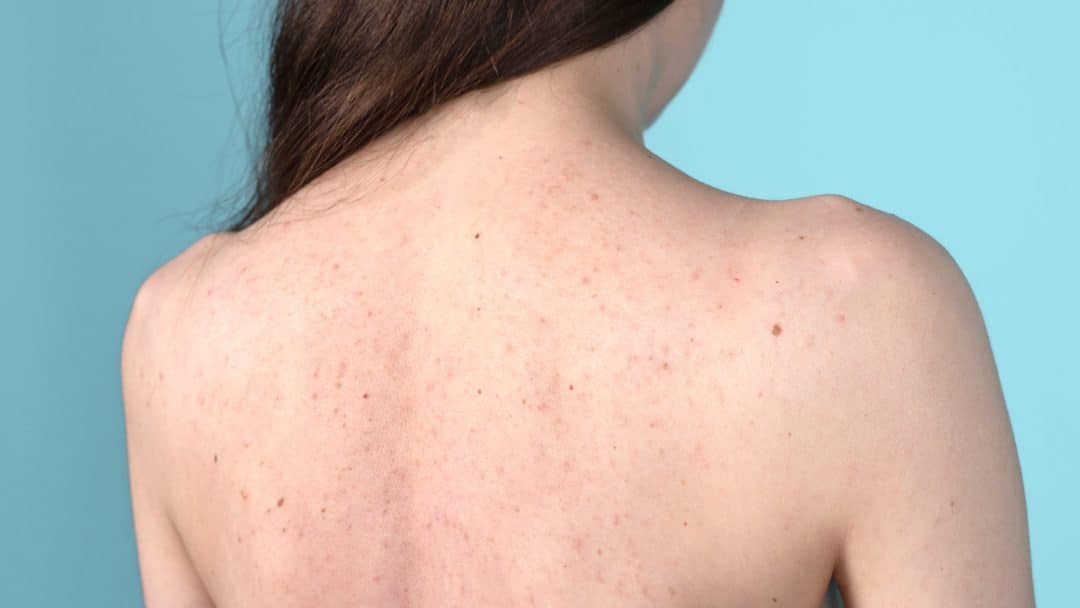 Bacne: descubra o que causa e como tratar a acne nas costas